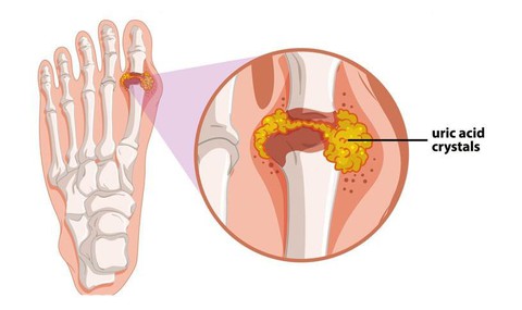Hạt Cần tây trong Baigout – “vũ khí” chiến thắng bệnh Gout lâu năm - Ảnh 1. Hạt Cần tây trong Baigout – “vũ khí” chiến thắng bệnh Gout lâu năm - Ảnh 1.