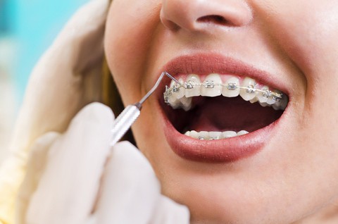 Vì sao cần nắn chỉnh răng? - Ảnh 1. Vì sao cần nắn chỉnh răng? - Ảnh 1.