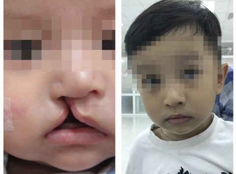 Làm gì khi phát hiện thai nhi bị hở hàm ếch? - Ảnh 1. Làm gì khi phát hiện thai nhi bị hở hàm ếch? - Ảnh 1.