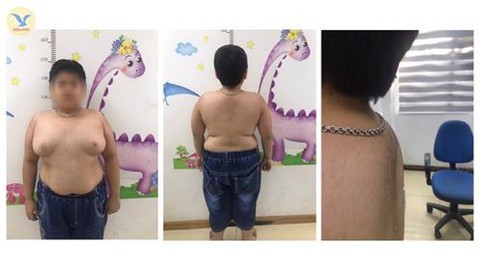 Trẻ vị thành niên mọc lông, bé nam có ngực lớn như phụ nữ vì lạm dụng thuốc - Ảnh 1. Trẻ vị thành niên mọc lông, bé nam có ngực lớn như phụ nữ vì lạm dụng thuốc - Ảnh 1.