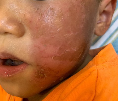 Da mặt bị bỏng rộp sau khi đeo mặt nạ siêu nhân - Ảnh 1. Da mặt bị bỏng rộp sau khi đeo mặt nạ siêu nhân - Ảnh 1.