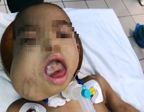 Bác sĩ Huế phối hợp với bác sĩ Mỹ, Pháp trị khối u quái dị cho bệnh nhi - Ảnh 1. Bác sĩ Huế phối hợp với bác sĩ Mỹ, Pháp trị khối u quái dị cho bệnh nhi - Ảnh 1.
