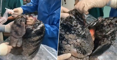 Sốc với lá phổi đen sì do hút thuốc của người hiến tạng - Ảnh 1. Sốc với lá phổi đen sì do hút thuốc của người hiến tạng - Ảnh 1.