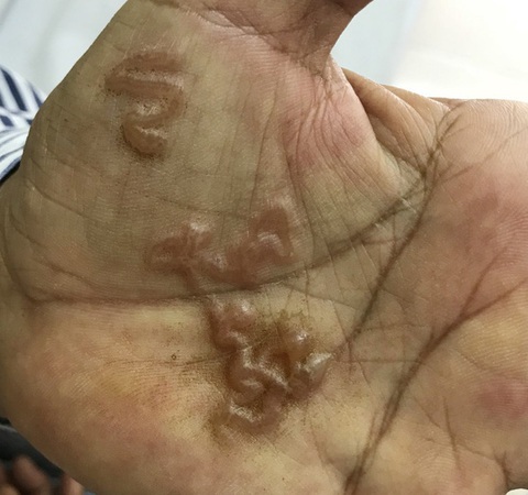 Cảnh báo bệnh giun sán chó liên tục tăng cao ở người - Ảnh 2. Cảnh báo bệnh giun sán chó liên tục tăng cao ở người - Ảnh 2.