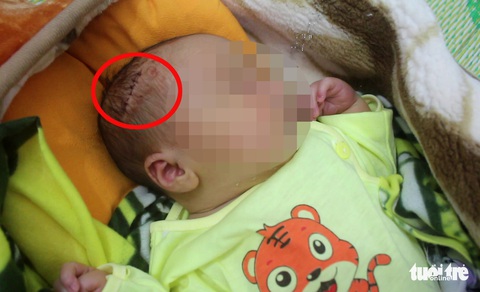 Vụ bé trai sinh mổ bị dao cắt rách da đầu, khâu 6 mũi: Bác sĩ thừa nhận sơ suất - Ảnh 1. Vụ bé trai sinh mổ bị dao cắt rách da đầu, khâu 6 mũi: Bác sĩ thừa nhận sơ suất - Ảnh 1.