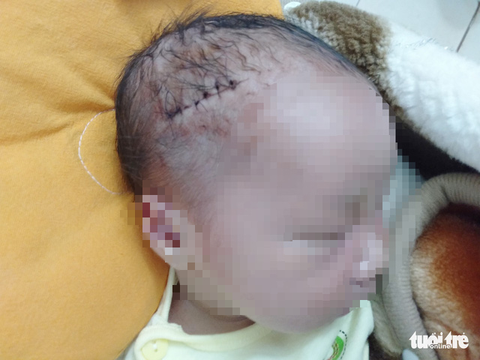 Bé trai sinh mổ bị dao cắt rách đầu, khâu 6 mũi - Ảnh 1. Bé trai sinh mổ bị dao cắt rách đầu, khâu 6 mũi - Ảnh 1.