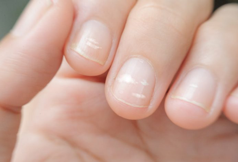 Móng tay bé bị đốm trắng có ý nghĩa gì? - Ảnh 1. Móng tay bé bị đốm trắng có ý nghĩa gì? - Ảnh 1.