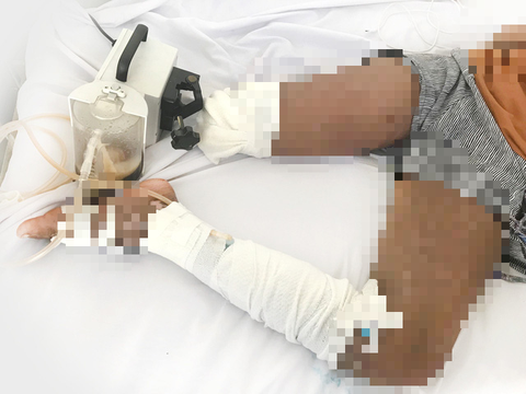 Xin ra viện đi thầy lang chữa rắn cắn, khiến con gái 13 tuổi bị cắt chân - Ảnh 1. Xin ra viện đi thầy lang chữa rắn cắn, khiến con gái 13 tuổi bị cắt chân - Ảnh 1.