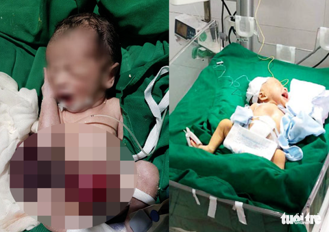 Cứu sống bệnh nhi bị ‘rơi’ nội tạng ra ngoài bụng - Ảnh 1. Cứu sống bệnh nhi bị ‘rơi’ nội tạng ra ngoài bụng - Ảnh 1.