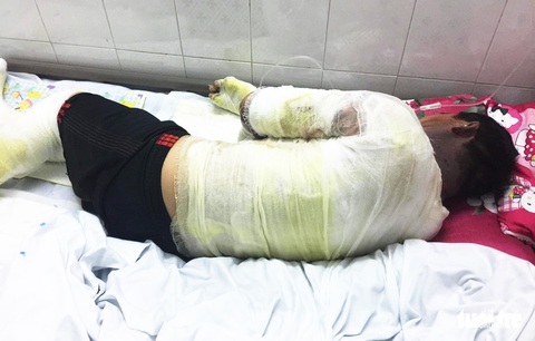 Cứu vợ phỏng xăng, cả hai vợ chồng nguy kịch - Ảnh 2. Cứu vợ phỏng xăng, cả hai vợ chồng nguy kịch - Ảnh 2.