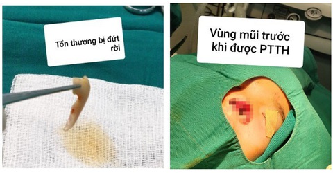 Lục thùng rác tìm mảnh mũi để làm lại mũi cho bé trai 5 tuổi - Ảnh 1. Lục thùng rác tìm mảnh mũi để làm lại mũi cho bé trai 5 tuổi - Ảnh 1.