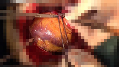 Cứu sống bệnh nhân vỡ tim sau khi bỏ qua quy trình thông thường - Ảnh 1. Cứu sống bệnh nhân vỡ tim sau khi bỏ qua quy trình thông thường - Ảnh 1.
