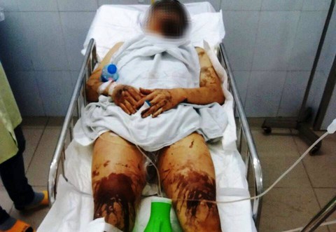Việt kiều về quê ăn tết bị tạt axit, cắt gân chân - Ảnh 1. Việt kiều về quê ăn tết bị tạt axit, cắt gân chân - Ảnh 1.
