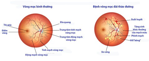 Bệnh đái tháo đường ảnh hưởng lên mắt như thế nào? - Ảnh 1. Bệnh đái tháo đường ảnh hưởng lên mắt như thế nào? - Ảnh 1.