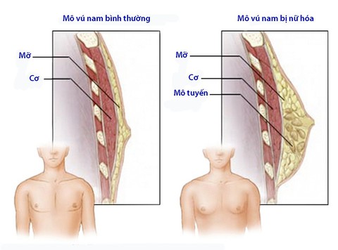 Nữ hóa tuyến vú ở nam giới - Ảnh 1. Nữ hóa tuyến vú ở nam giới - Ảnh 1.