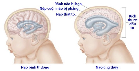 Não úng thủy - Ảnh 1. Não úng thủy - Ảnh 1.