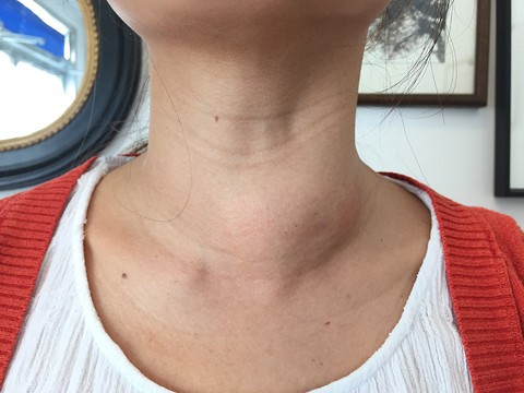 Các phương pháp điều trị bướu giáp keo - Ảnh 1. Các phương pháp điều trị bướu giáp keo - Ảnh 1.