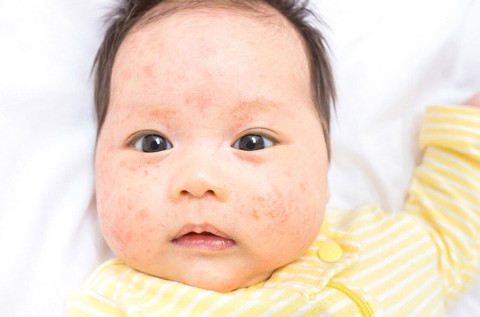Mẹo đơn giản để da bé khoẻ mạnh - Ảnh 1. Mẹo đơn giản để da bé khoẻ mạnh - Ảnh 1.