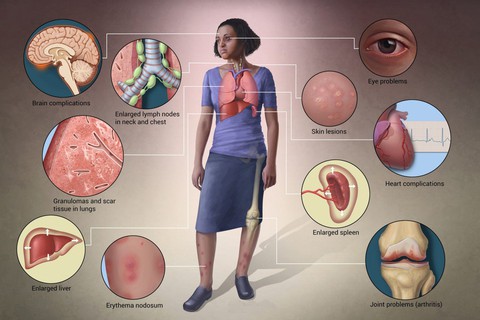 Bệnh sarcoidosis - Ảnh 1. Bệnh sarcoidosis - Ảnh 1.