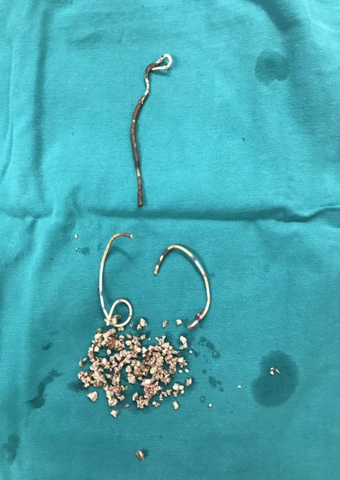 Nữ bệnh nhân quên tái khám rút stent nhựa trong thận và bàng quang - Ảnh 1. Nữ bệnh nhân quên tái khám rút stent nhựa trong thận và bàng quang - Ảnh 1.