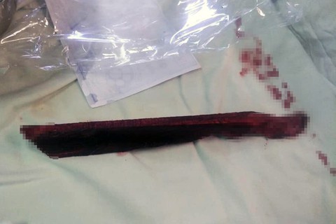 Bị thanh gỗ dài 18cm đâm xuyên thấu vùng chậu - Ảnh 1. Bị thanh gỗ dài 18cm đâm xuyên thấu vùng chậu - Ảnh 1.