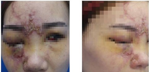 Mù mắt sau tiêm filler nâng mũi tại Đài Loan - Ảnh 1. Mù mắt sau tiêm filler nâng mũi tại Đài Loan - Ảnh 1.
