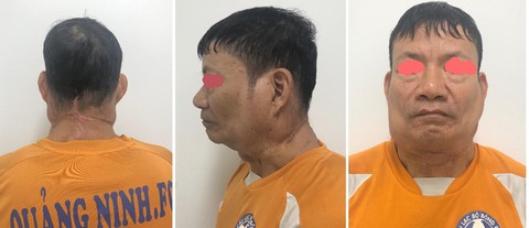 Phẫu thuật nhiều khối u khổng lồ cho cho người gấu - Ảnh 2. Phẫu thuật nhiều khối u khổng lồ cho cho người gấu - Ảnh 2.