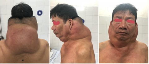 Phẫu thuật nhiều khối u khổng lồ cho cho người gấu - Ảnh 1. Phẫu thuật nhiều khối u khổng lồ cho cho người gấu - Ảnh 1.