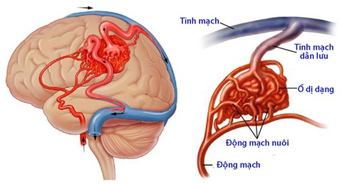 Dị dạng mạch máu dạng hang - Ảnh 1. Dị dạng mạch máu dạng hang - Ảnh 1.
