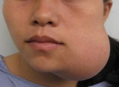 Một số điều cần biết về u men - Ảnh 1. Một số điều cần biết về u men - Ảnh 1.