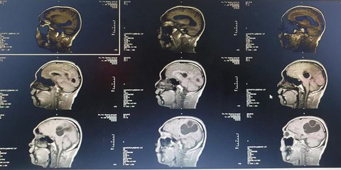 Ổ sán não khổng lồ trong não một nam giới ở Phú Thọ - Ảnh 1. Ổ sán não khổng lồ trong não một nam giới ở Phú Thọ - Ảnh 1.