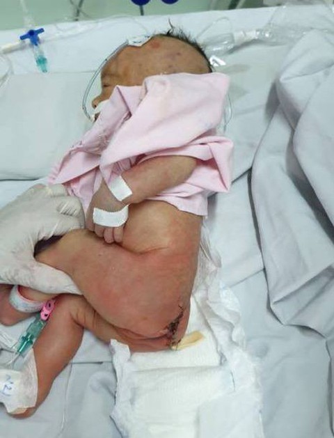 Cứu sống bé gái sơ sinh có bướu quái nặng gấp 1,5 lần cơ thể - Ảnh 2. Cứu sống bé gái sơ sinh có bướu quái nặng gấp 1,5 lần cơ thể - Ảnh 2.