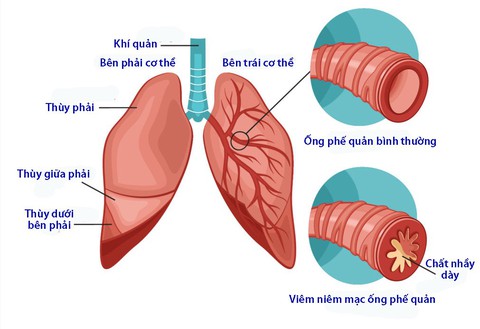 Phân biệt viêm phế quản do virus và viêm phế quản do vi khuẩn - Ảnh 1. Phân biệt viêm phế quản do virus và viêm phế quản do vi khuẩn - Ảnh 1.