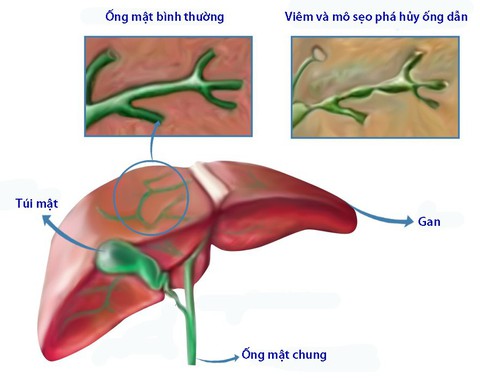 Xơ gan mật nguyên phát - Ảnh 1. Xơ gan mật nguyên phát - Ảnh 1.