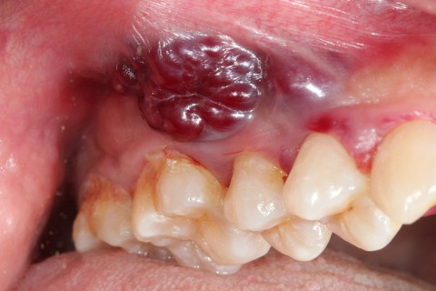 Ung thư miệng và họng - Ảnh 1. Ung thư miệng và họng - Ảnh 1.