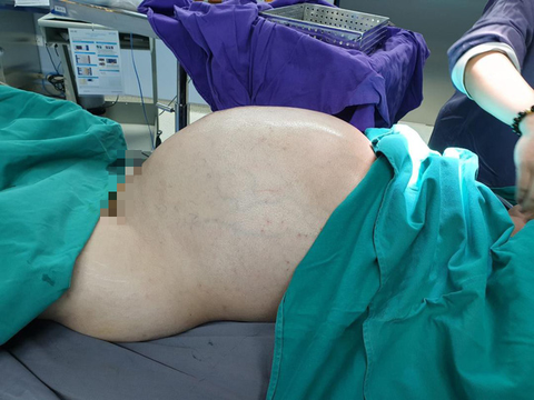 Phẫu thuật lấy khối u 25 kg từ bụng nam thanh niên - Ảnh 1. Phẫu thuật lấy khối u 25 kg từ bụng nam thanh niên - Ảnh 1.