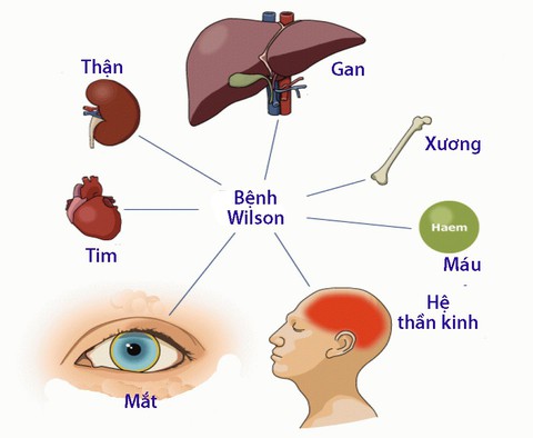 Bệnh Wilson - Ảnh 1. Bệnh Wilson - Ảnh 1.