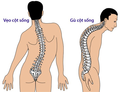 Bệnh lao xương - Ảnh 1. Bệnh lao xương - Ảnh 1.