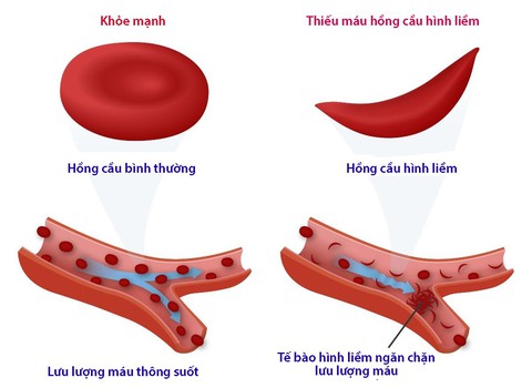 Bệnh thiếu máu hồng cầu hình liềm ở trẻ nhỏ - Ảnh 1. Bệnh thiếu máu hồng cầu hình liềm ở trẻ nhỏ - Ảnh 1.