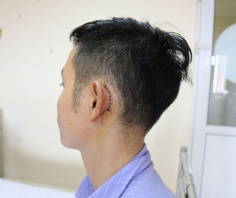 Điện thoại phát nổ khi sạc, phải mổ vá màng nhĩ - Ảnh 1. Điện thoại phát nổ khi sạc, phải mổ vá màng nhĩ - Ảnh 1.