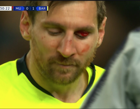 Messi đổ máu trong chiến thắng của Barca trước M.U - Ảnh 5. Messi đổ máu trong chiến thắng của Barca trước M.U - Ảnh 5.