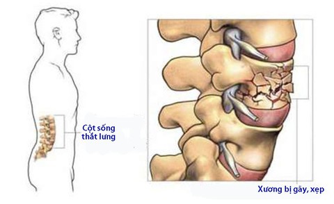 Gãy xẹp - Lún đốt sống - Ảnh 1. Gãy xẹp - Lún đốt sống - Ảnh 1.