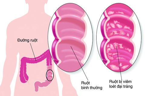 Bào tử lợi khuẩn LiveSpo COLON hỗ trợ điều trị viêm đại tràng - Ảnh 1. Bào tử lợi khuẩn LiveSpo COLON hỗ trợ điều trị viêm đại tràng - Ảnh 1.