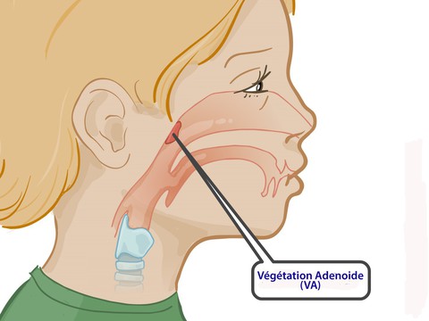 Viêm VA ở trẻ em - Ảnh 1. Viêm VA ở trẻ em - Ảnh 1.