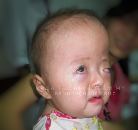 Việt Nam điều trị thành công cho bé hẹp hộp sọ hiếm gặp - Ảnh 1. Việt Nam điều trị thành công cho bé hẹp hộp sọ hiếm gặp - Ảnh 1.