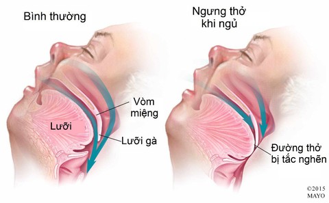Ngáy to vô lo hay đáng lo? - Ảnh 1. Ngáy to vô lo hay đáng lo? - Ảnh 1.