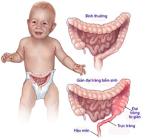 Giãn đại tràng bẩm sinh - Ảnh 1. Giãn đại tràng bẩm sinh - Ảnh 1.