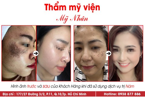 Sạch nám không tái phát nhờ điều trị theo phác đồ y học - Ảnh 1. Sạch nám không tái phát nhờ điều trị theo phác đồ y học - Ảnh 1.