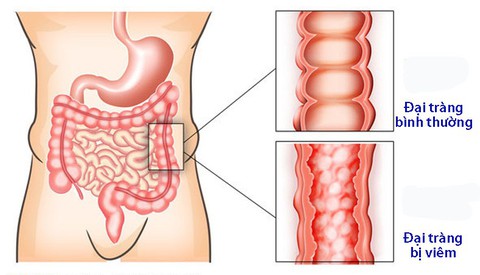 Viêm đại tràng co thắt mạn tính - Ảnh 1. Viêm đại tràng co thắt mạn tính - Ảnh 1.