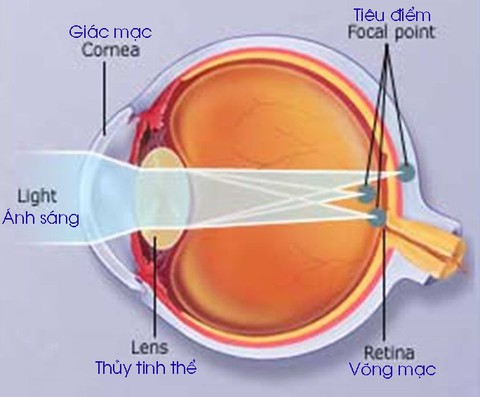Loạn thị, nguyên nhân và cách điều trị - Ảnh 1. Loạn thị, nguyên nhân và cách điều trị - Ảnh 1.